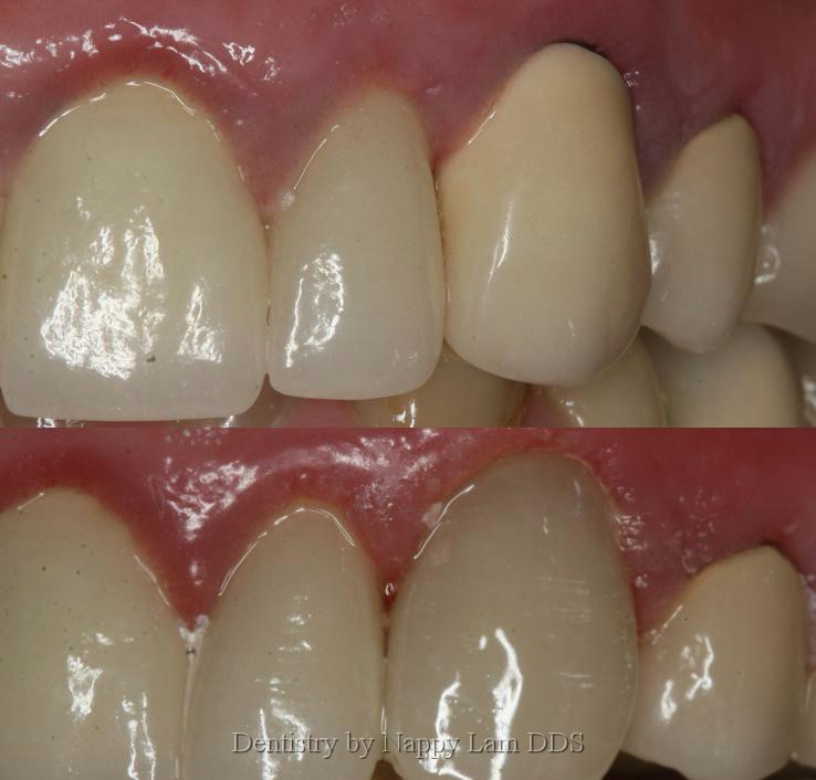 How To Tell If Tooth Decay Under Crown